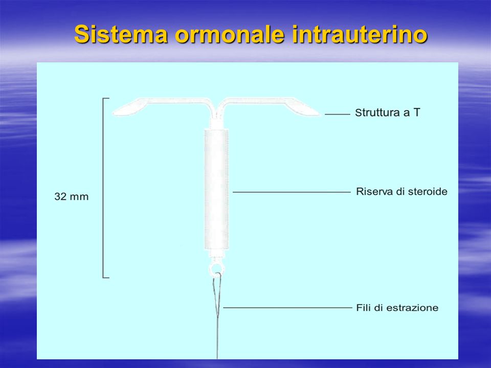 Sistema ormonale intrauterino