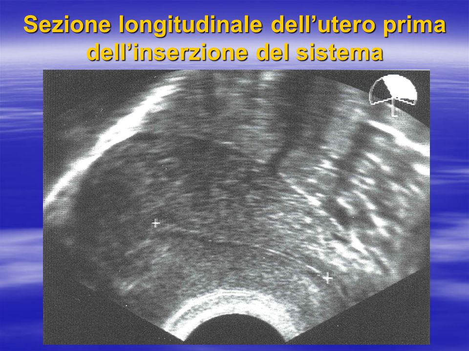 Sezione longitudinale dell’utero prima dell’inserzione del sistema