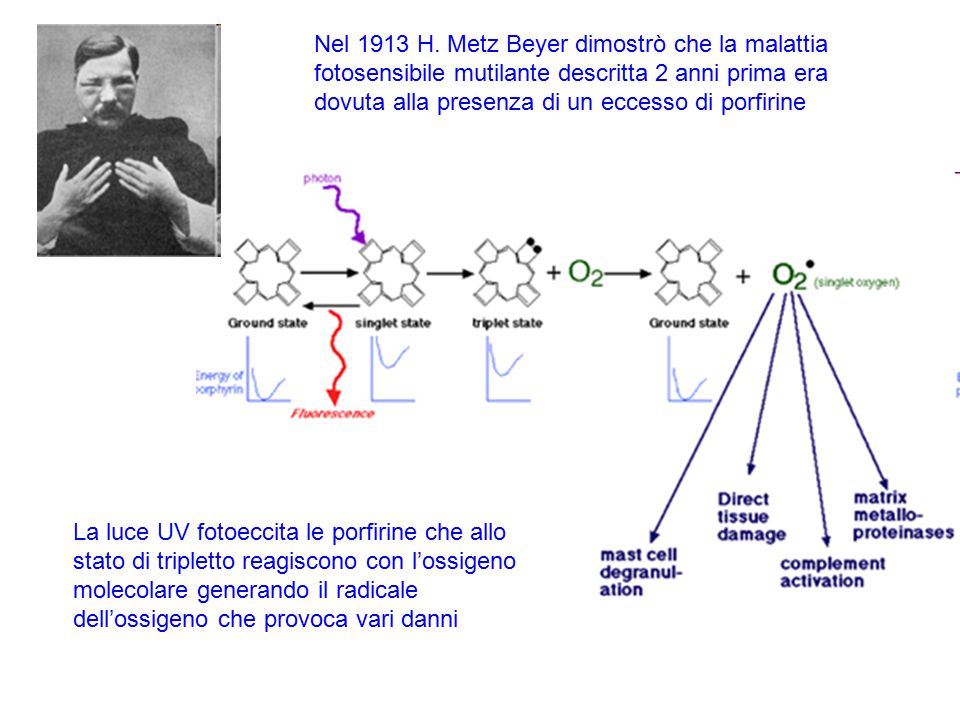 Nel 1913 H. Metz Beyer dimostrò che la malattia fotosensibile mutilante descritta 2 anni prima era dovuta alla presenza di un eccesso di porfirine