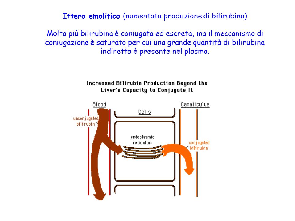 Ittero emolitico (aumentata produzione di bilirubina)
