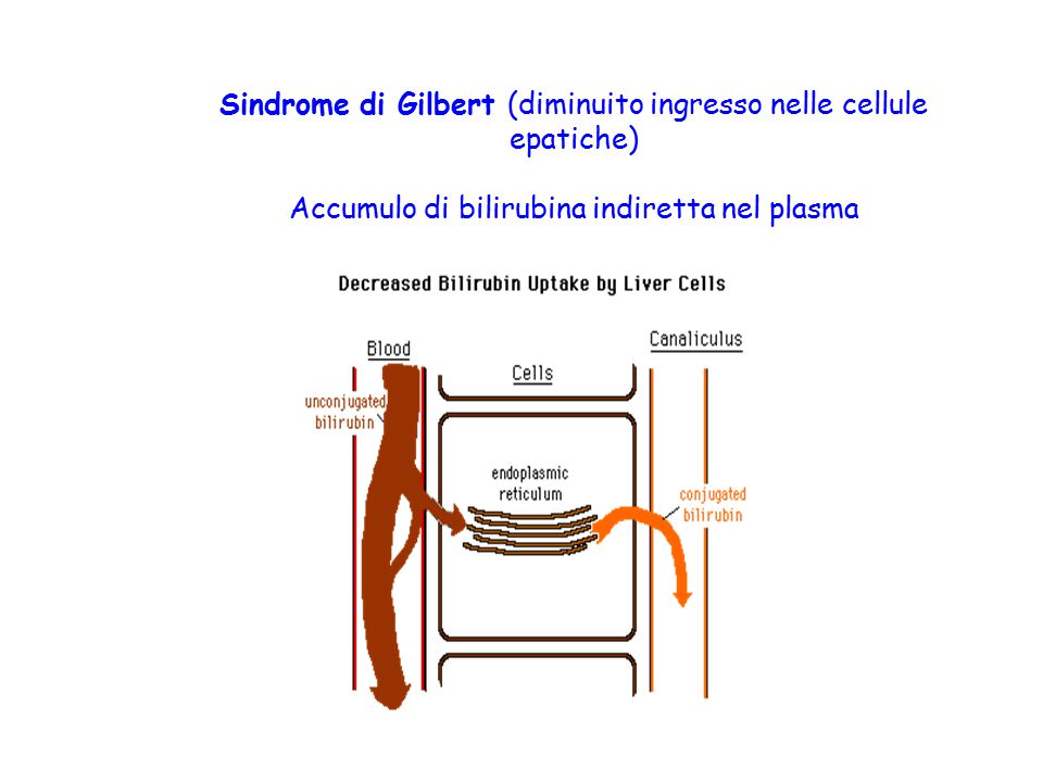 Sindrome di Gilbert (diminuito ingresso nelle cellule epatiche) Accumulo di bilirubina indiretta nel plasma.