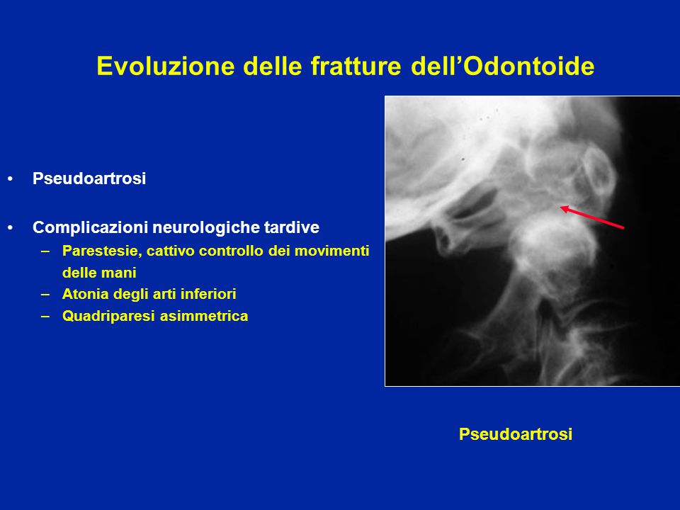 Evoluzione delle fratture dell’Odontoide