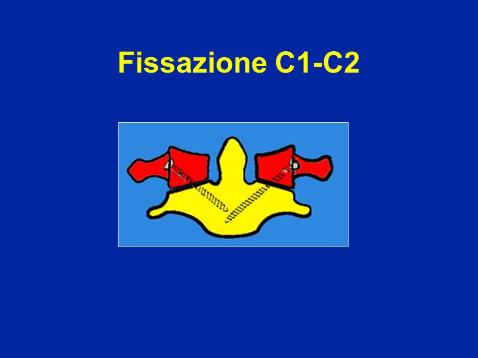 Fissazione C1-C2