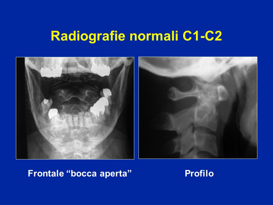 Radiografie normali C1-C2