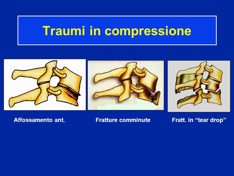 Traumi in compressione