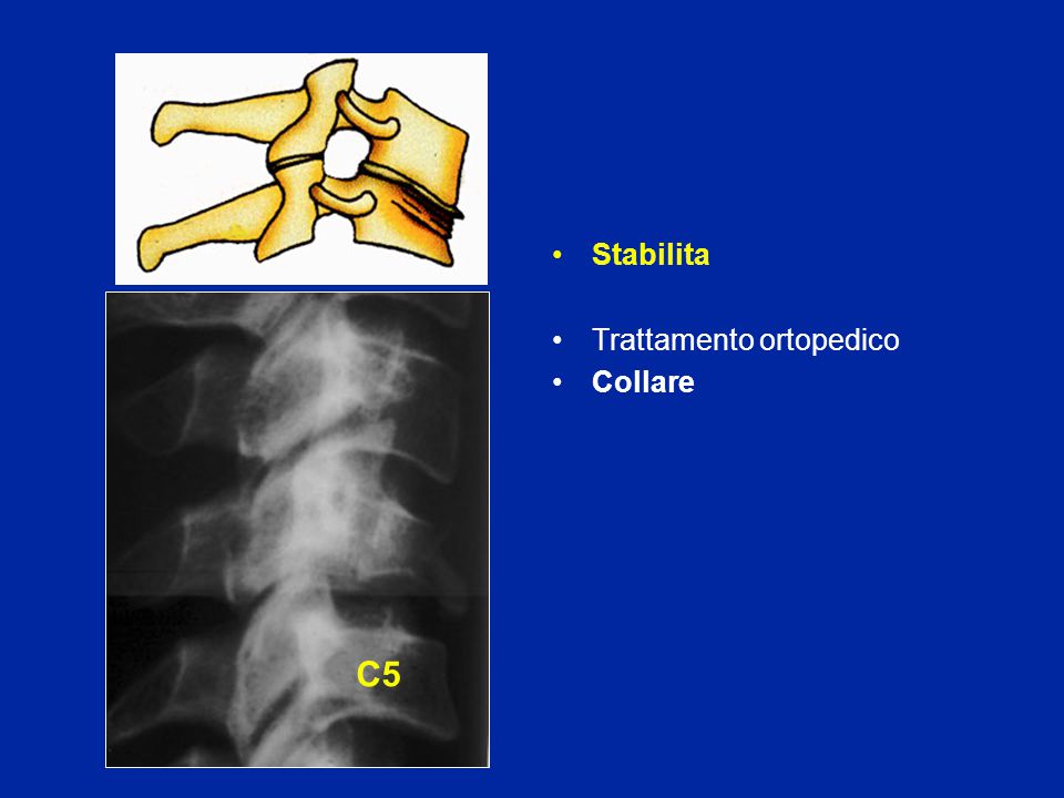 Stabilita Trattamento ortopedico Collare C5