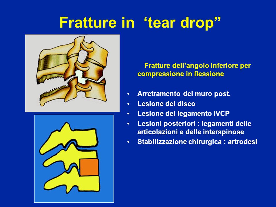 Fratture in ‘tear drop