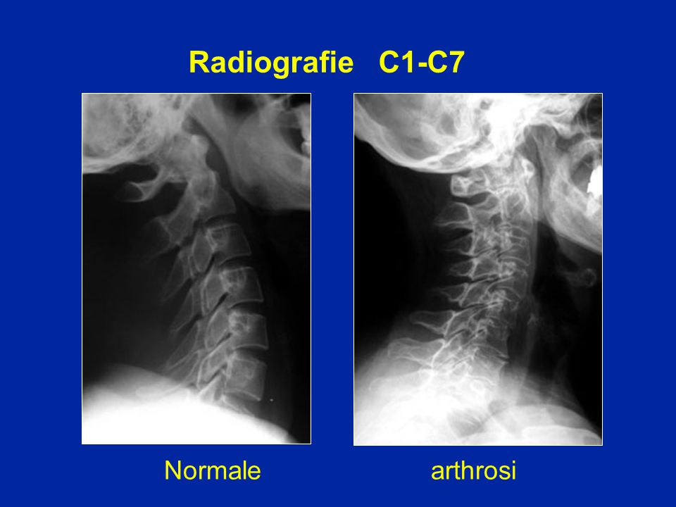 Radiografie C1-C7 Normale arthrosi