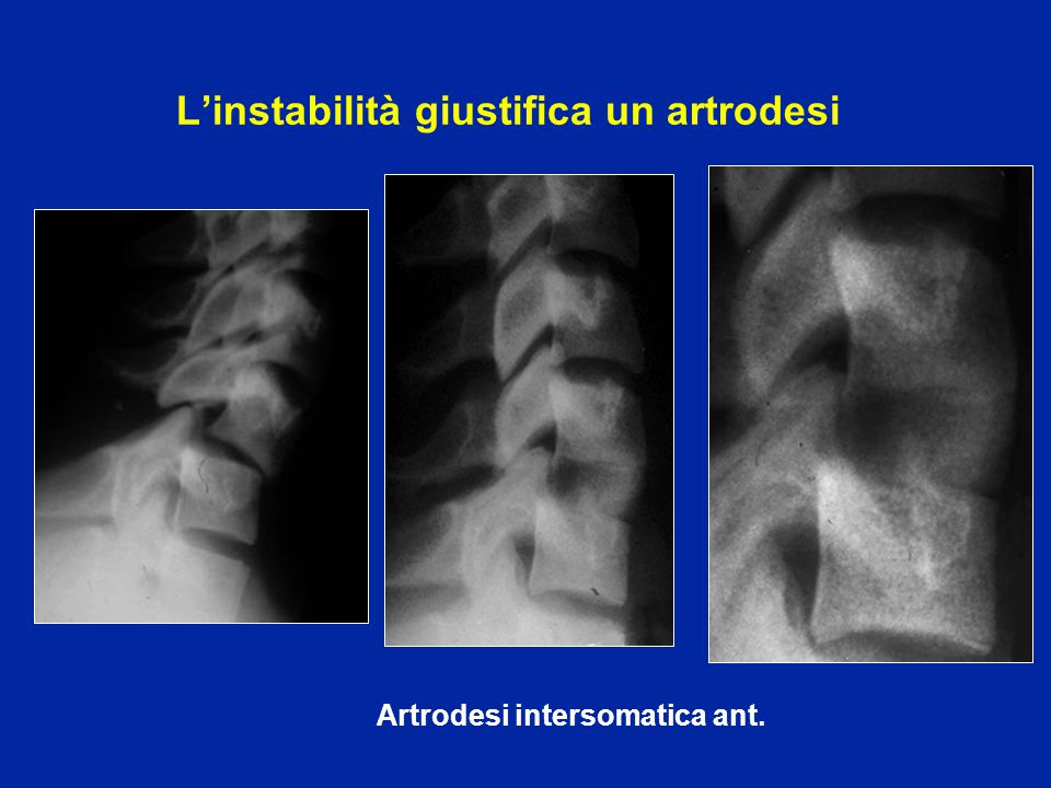 L’instabilità giustifica un artrodesi