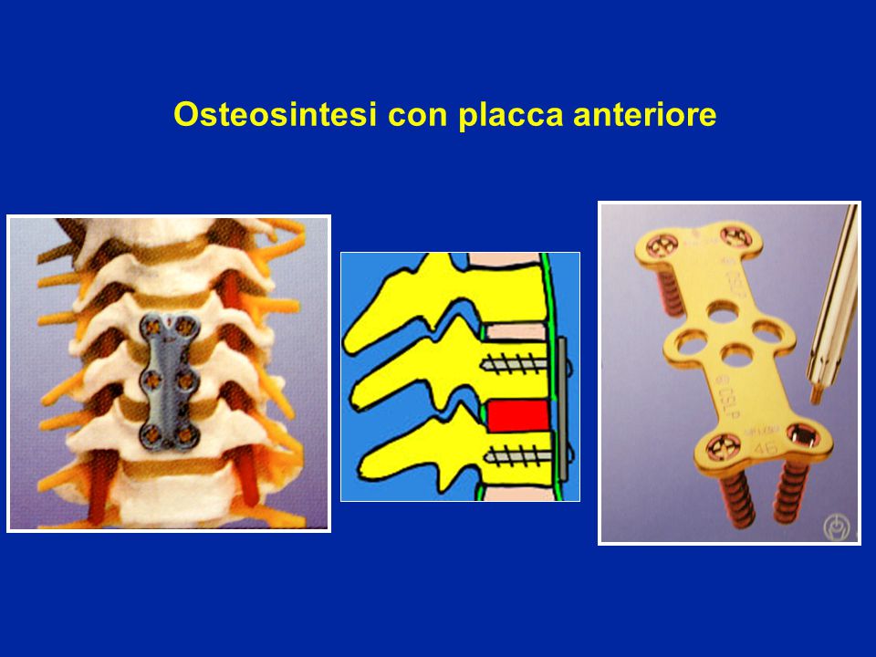Osteosintesi con placca anteriore