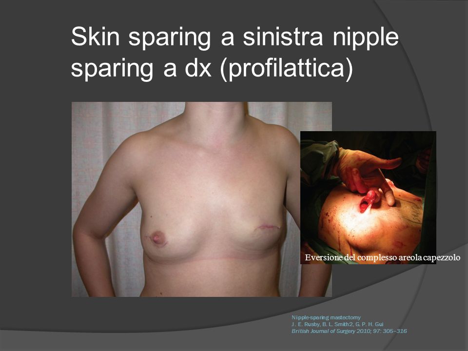Skin sparing a sinistra nipple sparing a dx (profilattica)