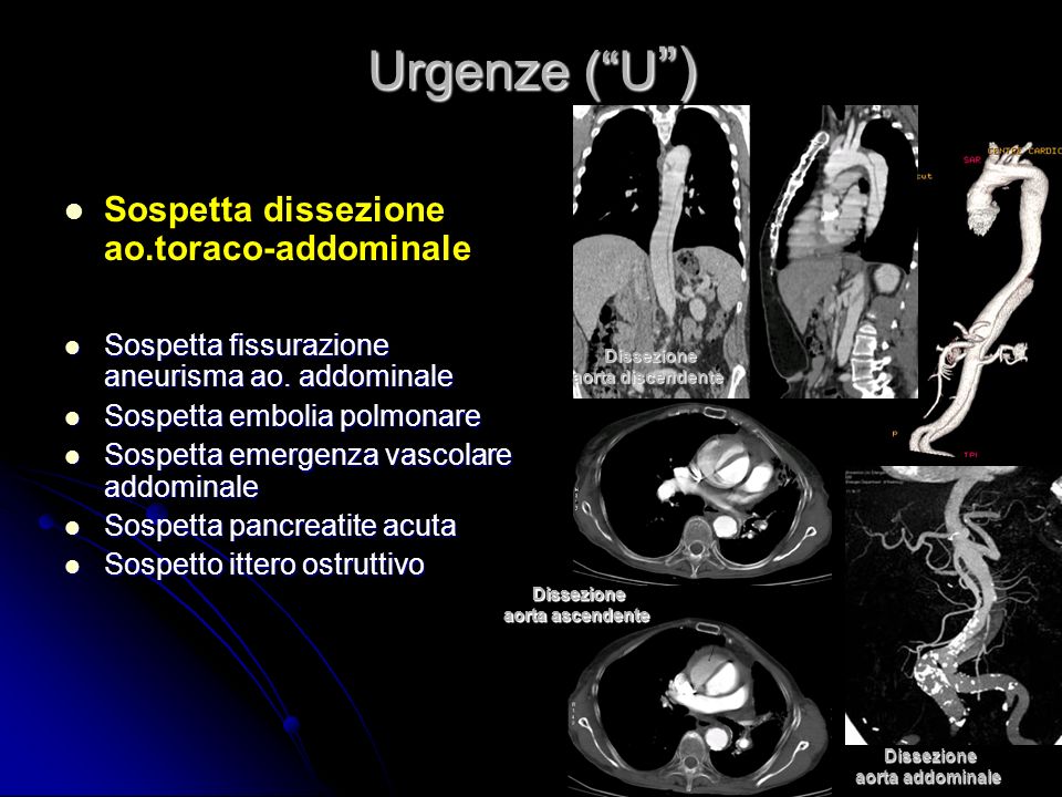 Urgenze ( U ) Sospetta dissezione ao.toraco-addominale