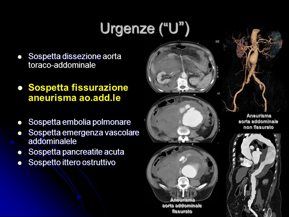 Urgenze ( U ) Sospetta fissurazione aneurisma ao.add.le