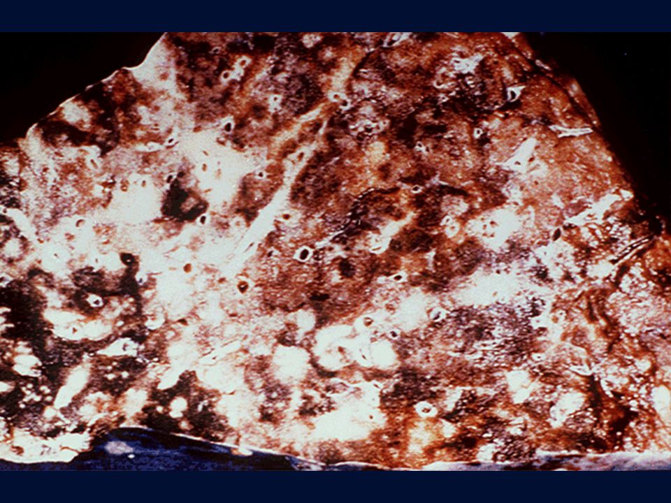 Polmonite erpetica, aspetto macroscopico