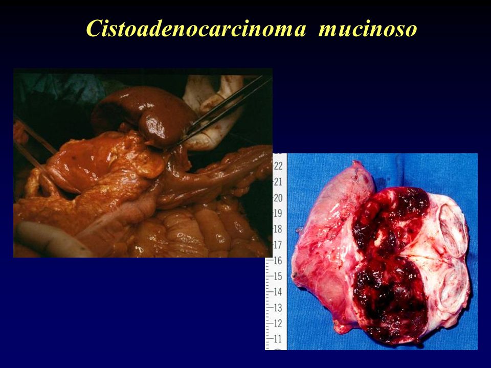 Cistoadenocarcinoma mucinoso