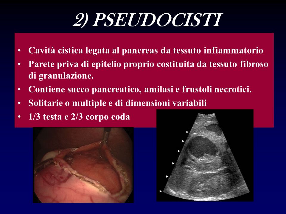2) PSEUDOCISTI Cavità cistica legata al pancreas da tessuto infiammatorio.