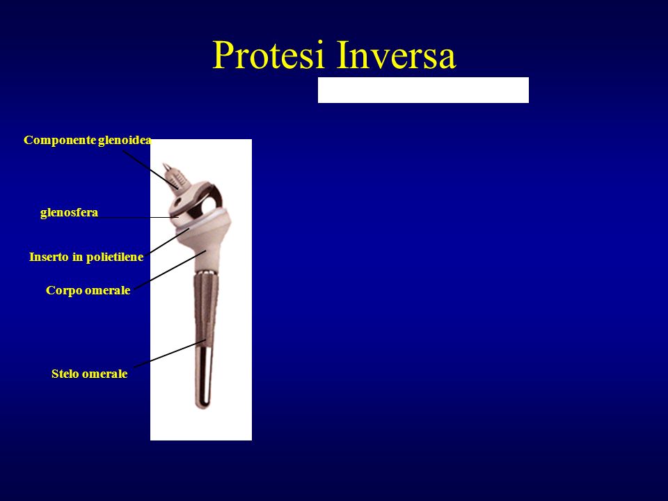 Protesi Inversa Componente glenoidea glenosfera Inserto in polietilene