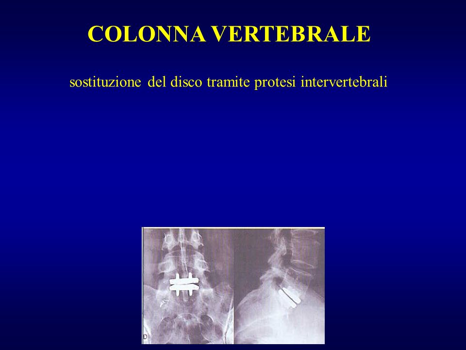 COLONNA VERTEBRALE sostituzione del disco tramite protesi intervertebrali