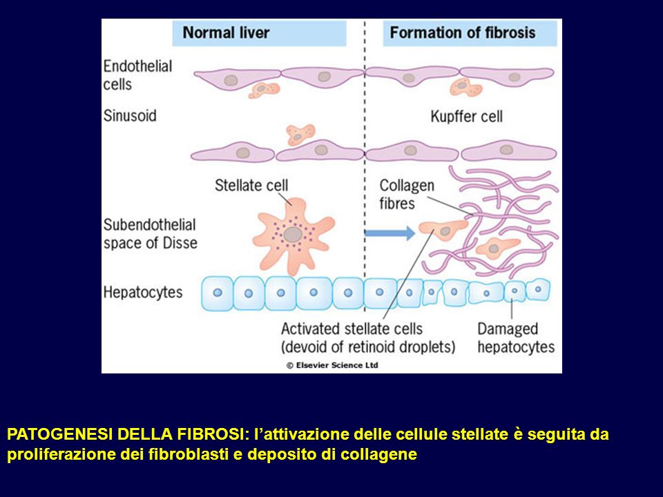 PATOGENESI DELLA FIBROSI: l’attivazione delle cellule stellate è seguita da proliferazione dei fibroblasti e deposito di collagene