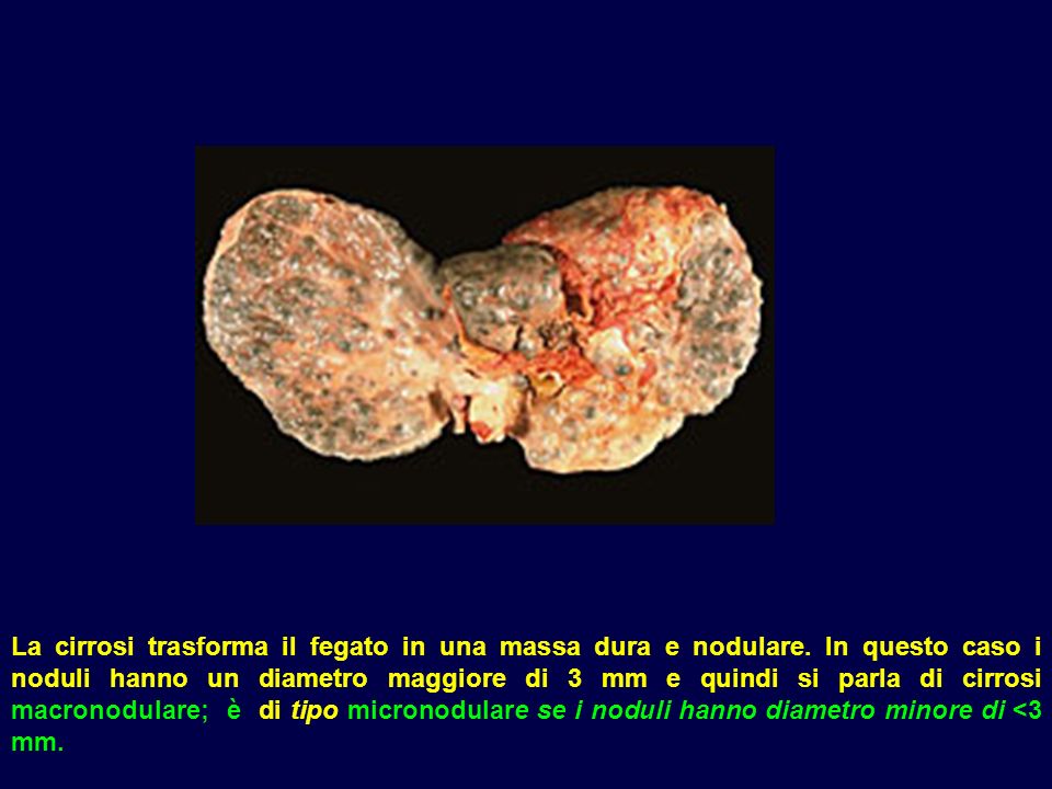La cirrosi trasforma il fegato in una massa dura e nodulare