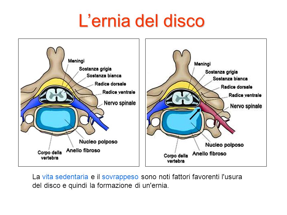 L’ernia del disco La vita sedentaria e il sovrappeso sono noti fattori favorenti l usura del disco e quindi la formazione di un ernia.