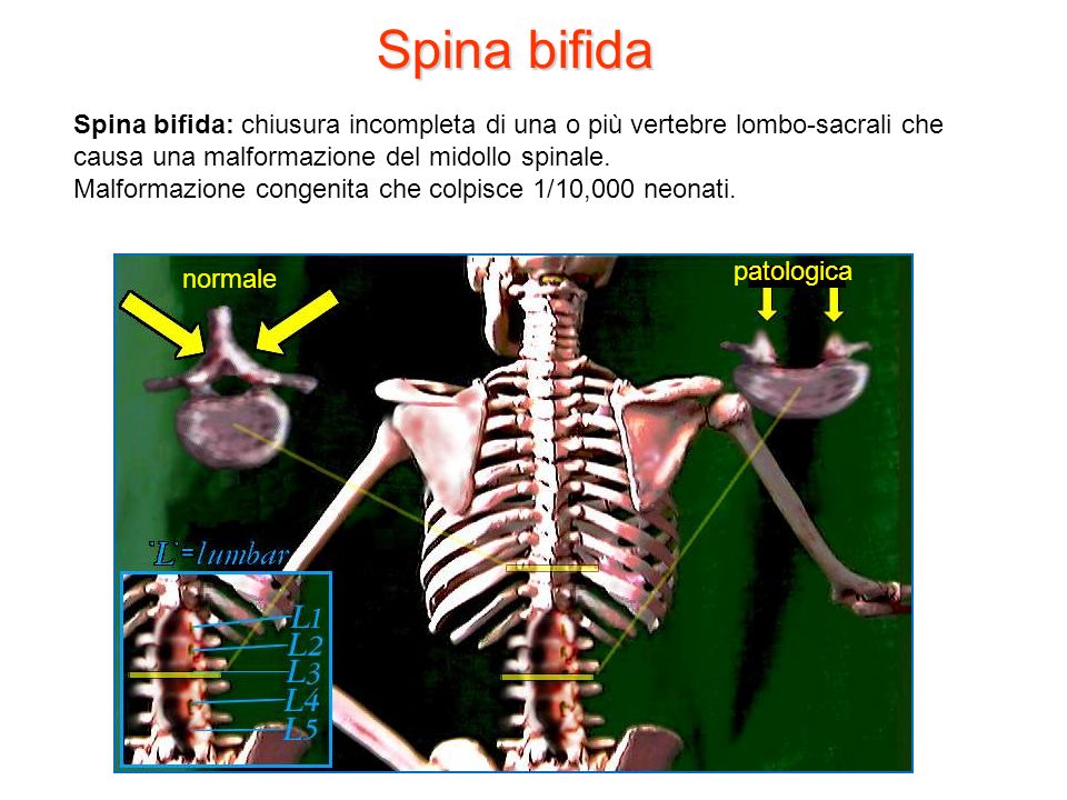 Spina bifida Spina bifida: chiusura incompleta di una o più vertebre lombo-sacrali che causa una malformazione del midollo spinale.