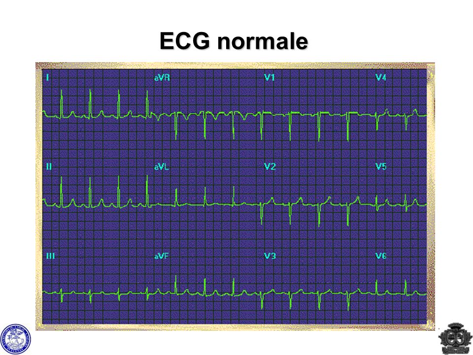ECG normale