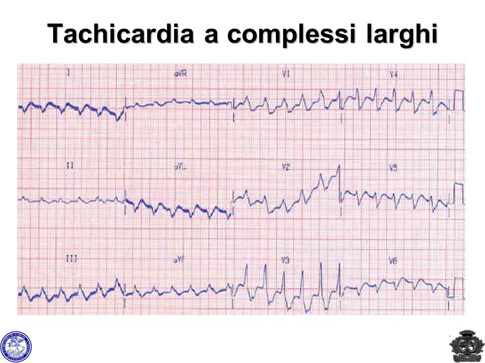 Tachicardia a complessi larghi