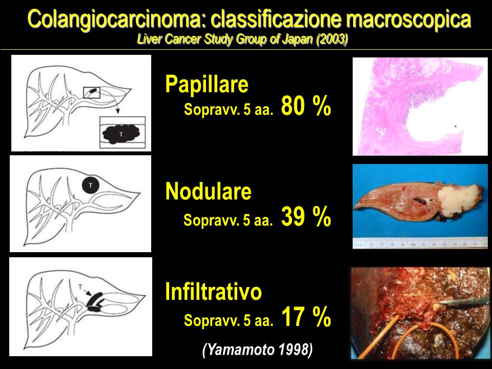 Colangiocarcinoma: classificazione macroscopica