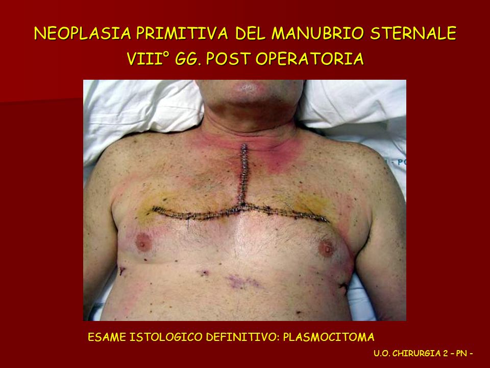 NEOPLASIA PRIMITIVA DEL MANUBRIO STERNALE VIII° GG. POST OPERATORIA