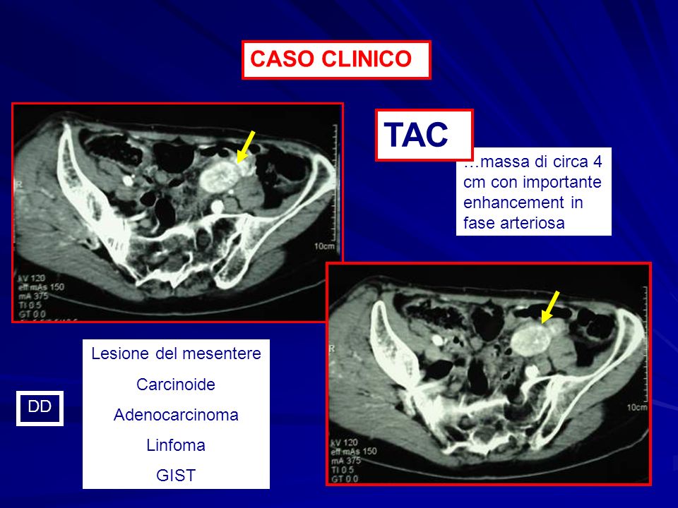 CASO CLINICO TAC. …massa di circa 4 cm con importante enhancement in fase arteriosa. Lesione del mesentere.