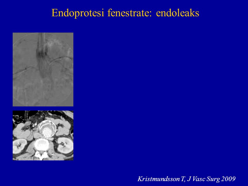Endoprotesi fenestrate: endoleaks