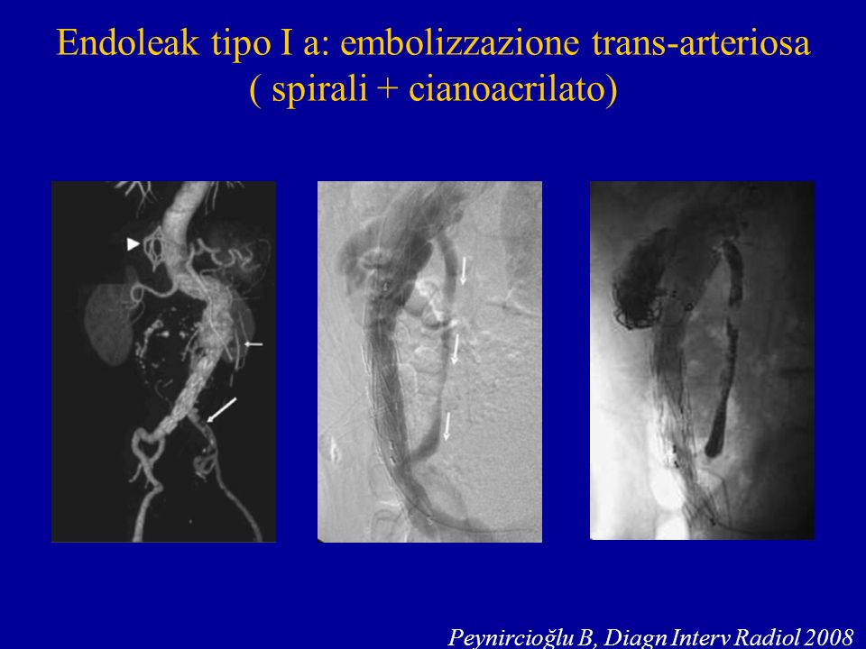 Endoleak tipo I a: embolizzazione trans-arteriosa
