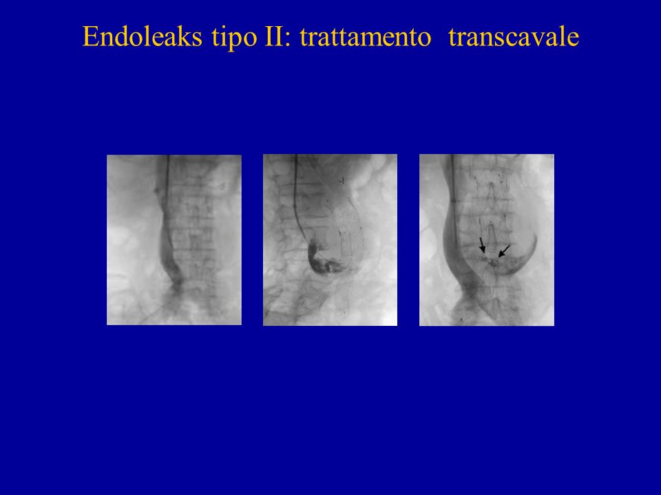 Endoleaks tipo II: trattamento transcavale