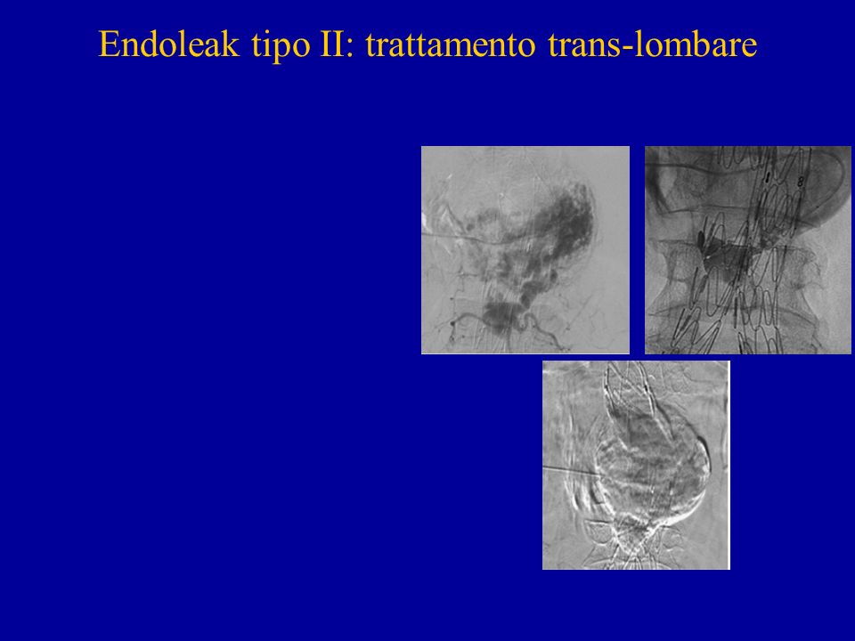 Endoleak tipo II: trattamento trans-lombare