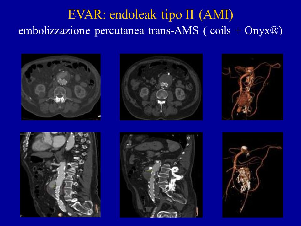 EVAR: endoleak tipo II (AMI) embolizzazione percutanea trans-AMS ( coils + Onyx®)