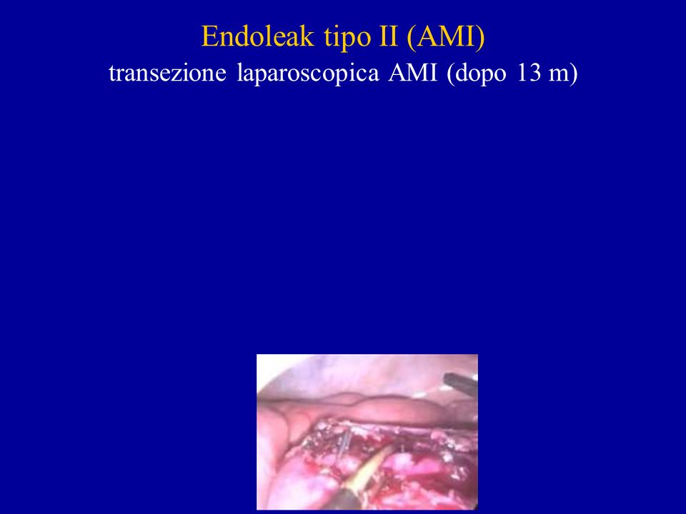 Endoleak tipo II (AMI) transezione laparoscopica AMI (dopo 13 m)