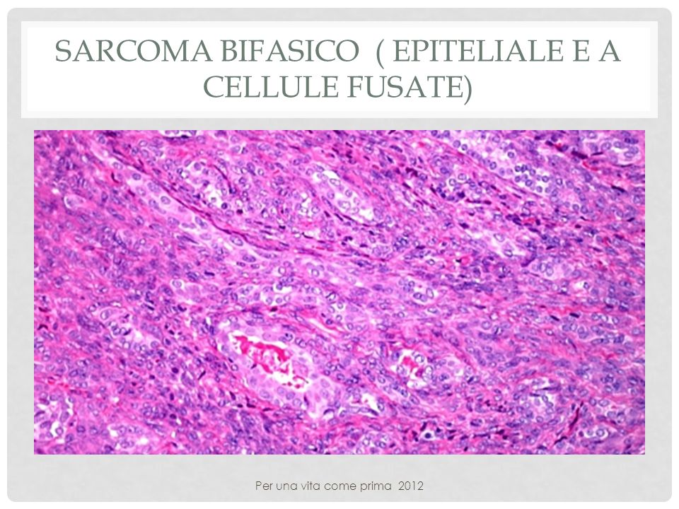 Sarcoma bifasico ( epiteliale e a cellule fusate)