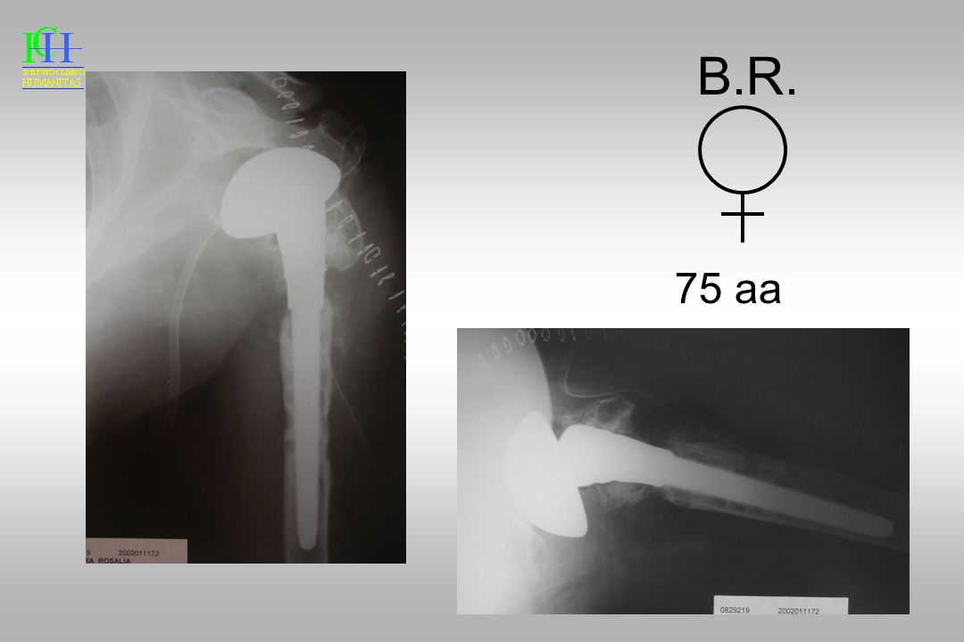 B.R. 75 aa Si programm a e si esegue rms e impianto di endoprotesi