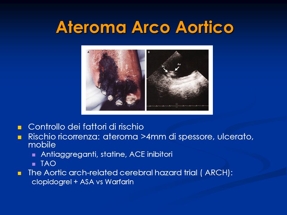 Ateroma Arco Aortico Controllo dei fattori di rischio