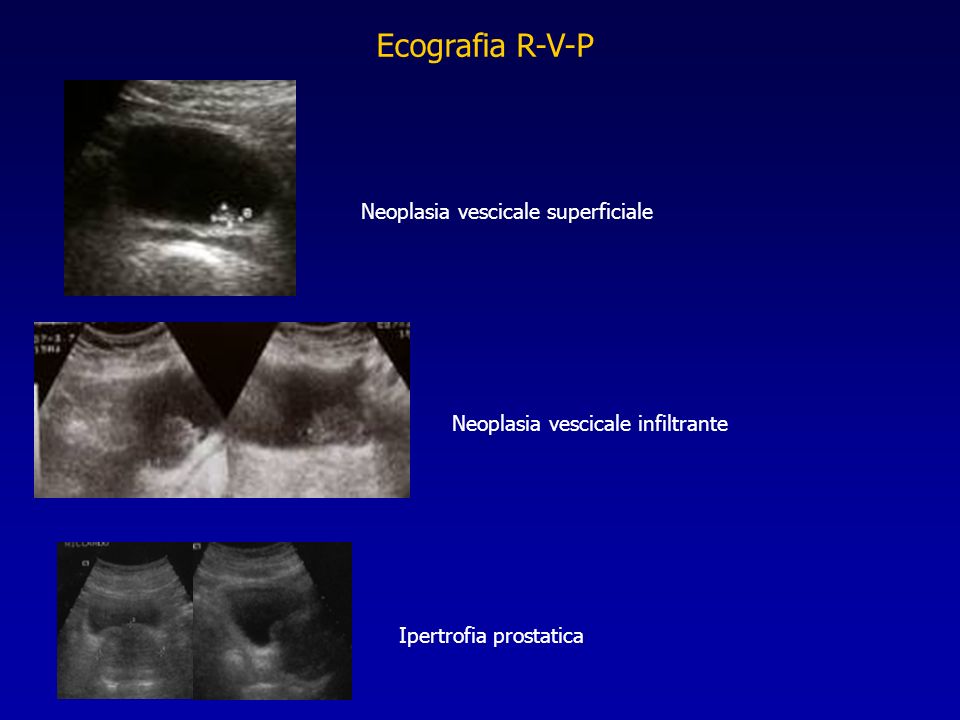 Ecografia R-V-P Neoplasia vescicale superficiale