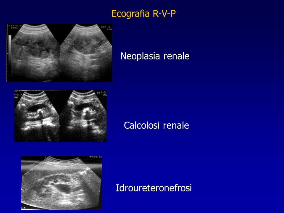 Ecografia R-V-P Neoplasia renale Calcolosi renale Idroureteronefrosi