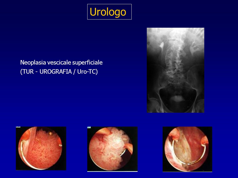 Urologo Neoplasia vescicale superficiale (TUR - UROGRAFIA / Uro-TC)
