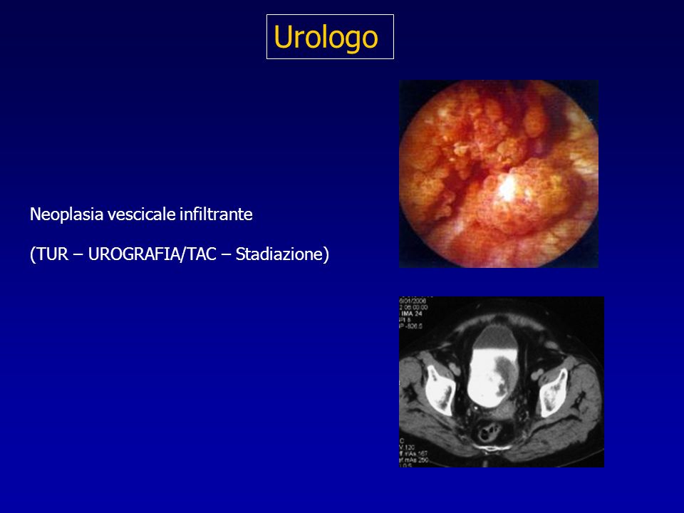 Urologo Neoplasia vescicale infiltrante