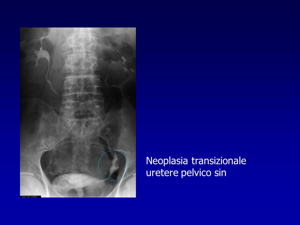 Neoplasia transizionale uretere pelvico sin
