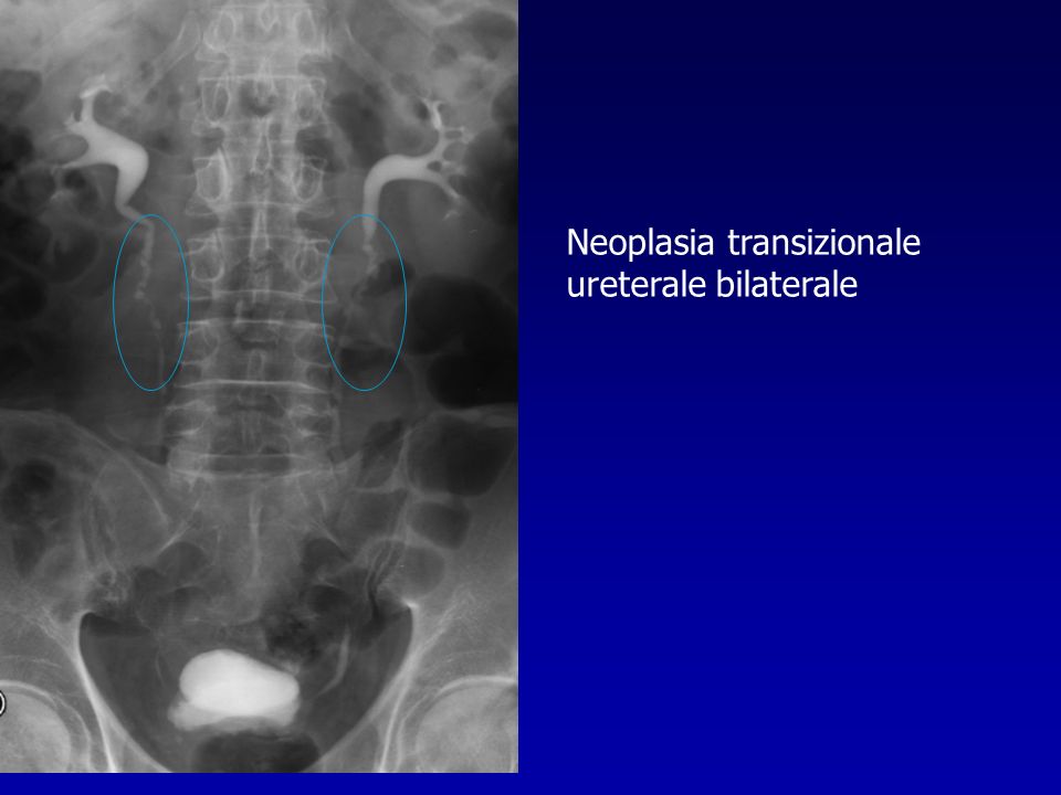 Neoplasia transizionale ureterale bilaterale