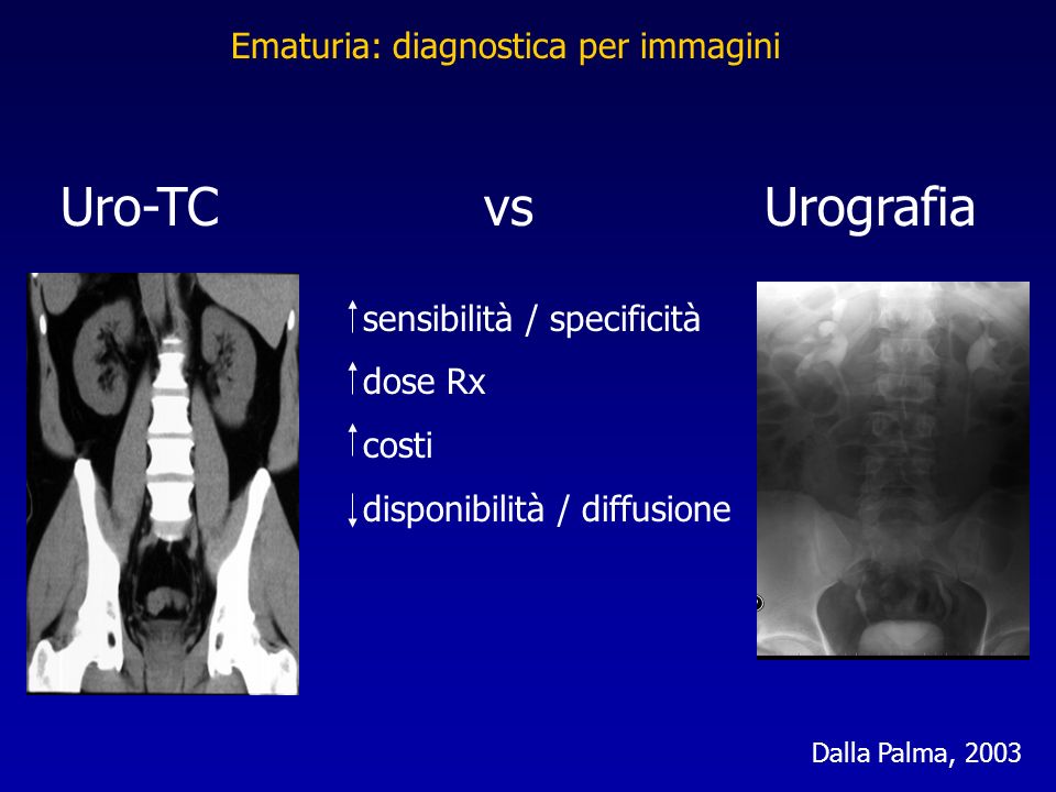 Uro-TC vs Urografia Ematuria: diagnostica per immagini