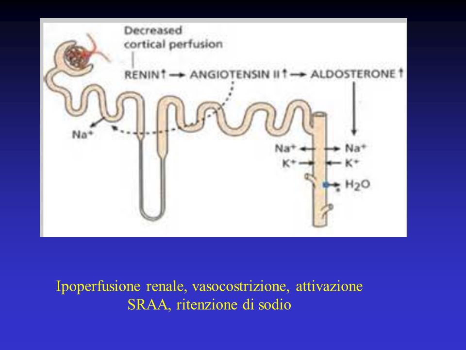 Ipoperfusione renale, vasocostrizione, attivazione SRAA, ritenzione di sodio