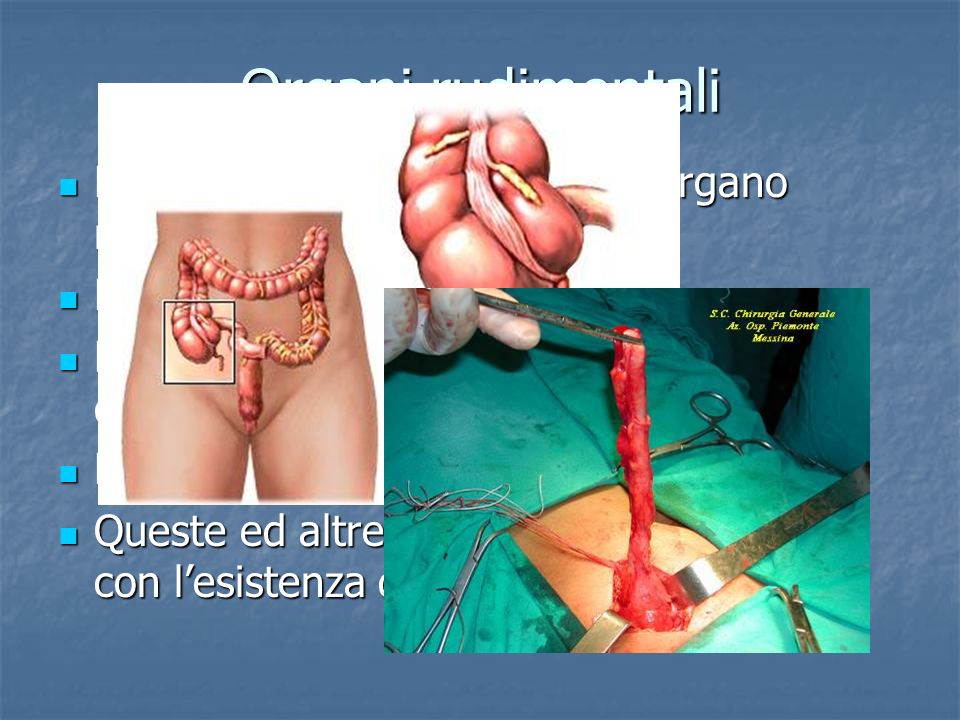 Organi rudimentali L’appendice vermiforme è un organo rudimentale