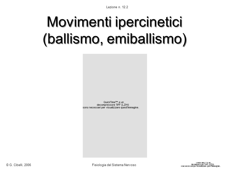 Movimenti ipercinetici (ballismo, emiballismo)